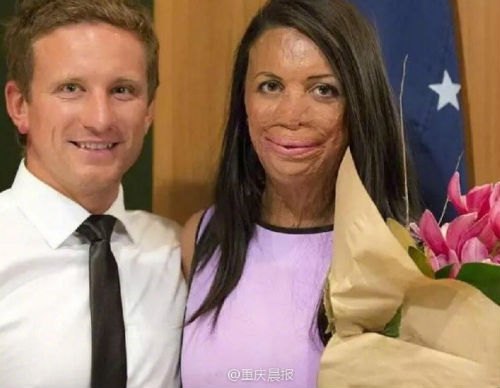 美女模特被大火毁容但她男朋友不离不弃六年相守